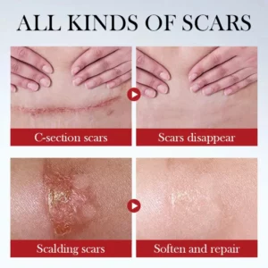 Scar Removal Cream Repair Stretch Marks Burn Acne Surgical Acne Scar Ointment Herbal Treatment Gel Whitening Beauty Health Care - Image 4